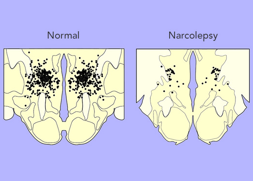 narcolepsy with cataplexy medications